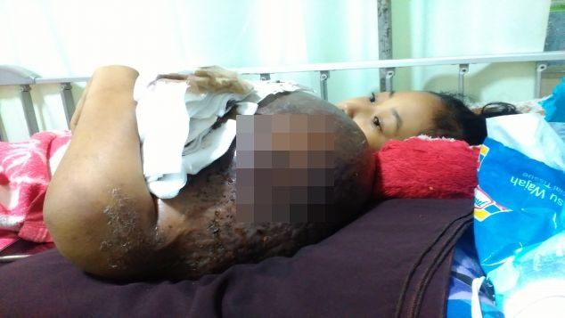 Bantu adik disa melawan kanker osteosarcoma