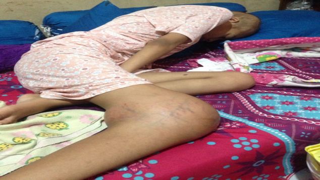 BANTU NURUL MELAWAN KANKER OSTEOSARCOMA