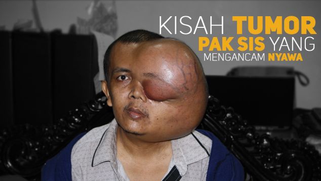 Bantu Operasi Kanker Pak Sis