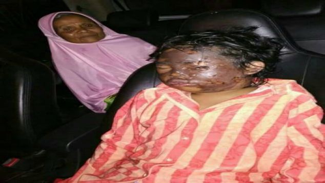 Bantu Pengobatan Rachel Untuk Senyum Kembali