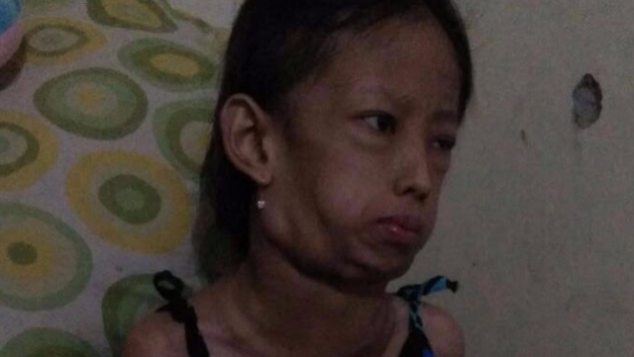 Sembuhkan Tia dari Kanker Getah Bening