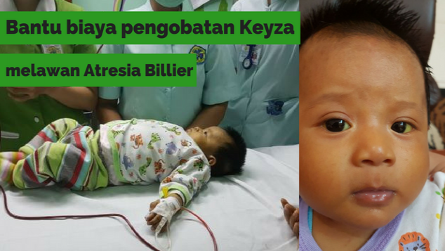 Gerakan hati bantu bayi Keyza Atresia Billier