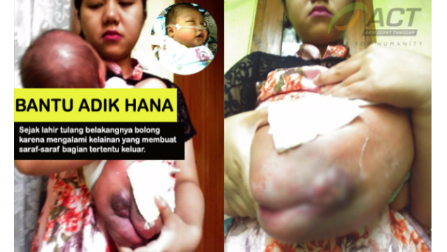 Bantu Hana, Segera Operasi Tulang Belakang