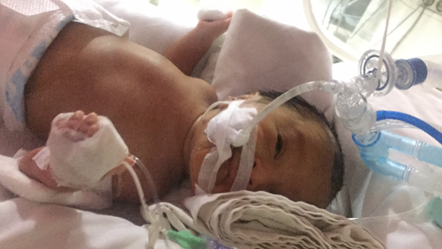 Kenar, bayi lahir prematur dengan RDS