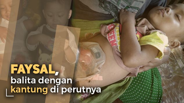 Faysal, Balita 3th Hidup Dengan Usus Di Luar Perut