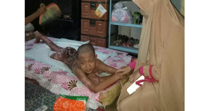 Bantu Pengobatan Adik Wahyu Luka Bakar Amputasi