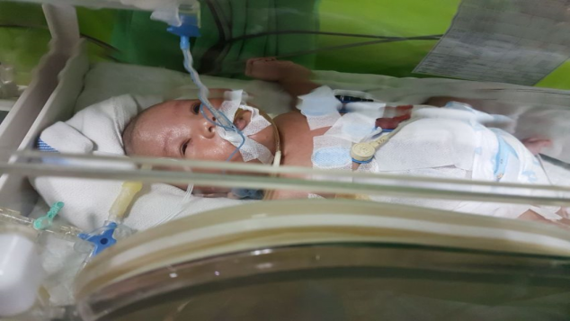 Bantu Umar Bayi GASTROSCHISIS (usus di luar perut)