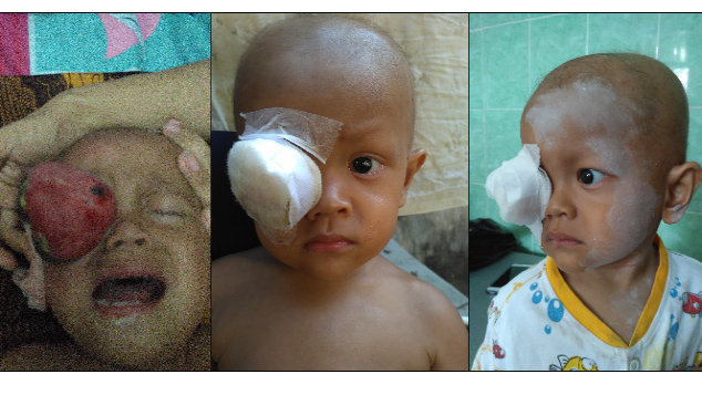 Bantu Fauzan Lawan Kanker Mata (Rhabdomyosarcoma)