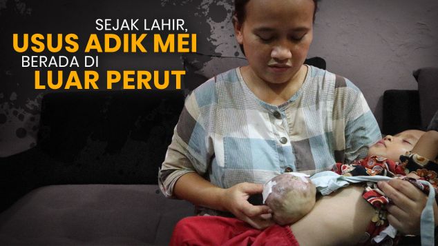 3 Thn, Adik Mei Hidup Dengan Benjolan Berisi Usus