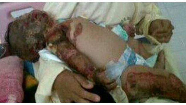 #BantuElvina#BalitaKotraktur Yatim Piatu Sembuh