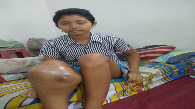 Kita Bisa Sembuhkan Kanker Tulang Piola