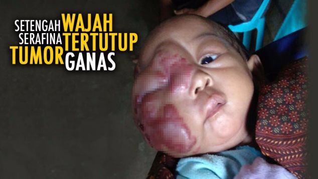 Bantu Serafina Angkat Tumor Kulit Ganas