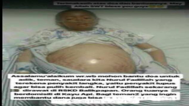 Mari kita membantu adik kita dari penyakit lupus