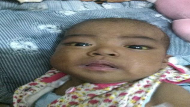 Bantu Vina Sembuh dari Atresia Bilier Sirosis Hati