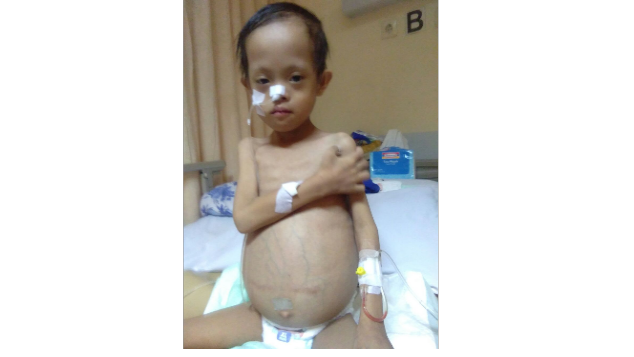 Azzam menderita down syndrome dan Tumor Teratoma