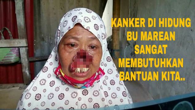 Bantu Janda miskin penderita kanker dihidung