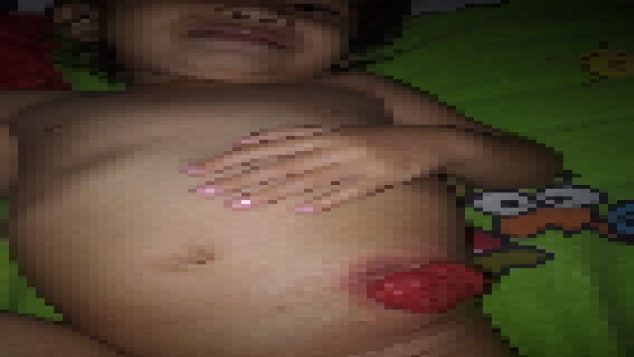 Bantu Arsy Sembuh dari Atresia Ani