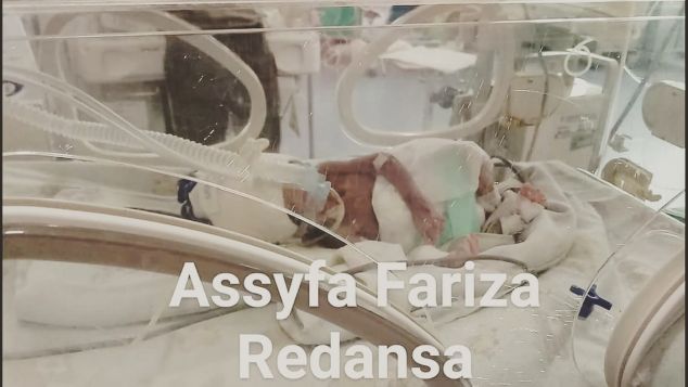 Pelunasan Biaya perawatan Assyifa Si Bayi prematur
