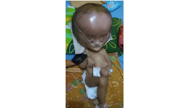 Bantuan Untuk Ade Ahdan , Penderita Hidrosefalus