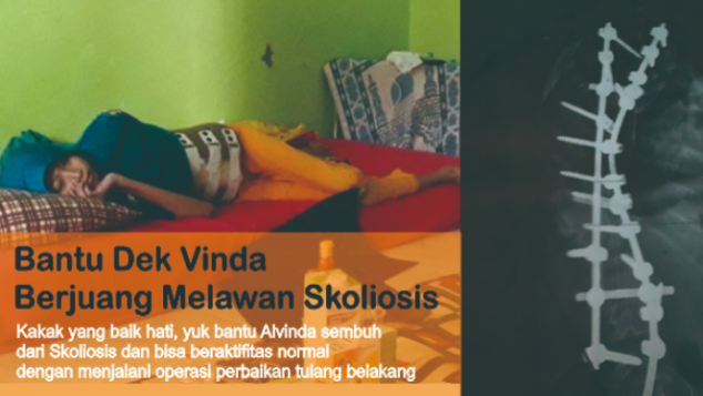 Skoliosis Adalah Kelainan Pada Tulang Belakang Karena Skoliosis Adalah Kelainan Pada Tulang Belakang Karena