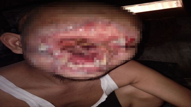 BANTU BAPAK SANALI SEMBUH DARI KANKER KULIT
