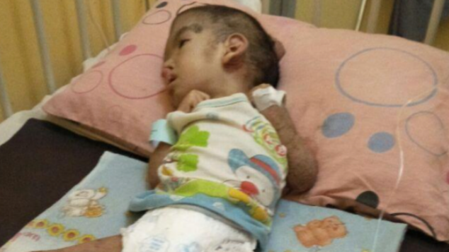 Anugrah Anak Penderita Gizi Buruk dan Gagal Tubuh