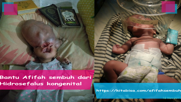 Bantu Afifah sembuh dari hidrosefalus kongenital
