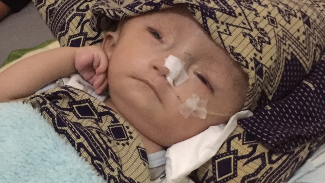 Operasi Besar Dibutuhkan Untuk Kepala Baby Noah