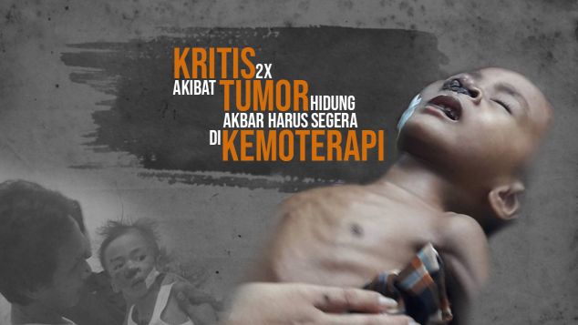Akbar, Balita 2thn Kesulitan Bernapas Karena Tumor