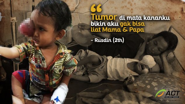 Balita Rusdin, Terancam Buta Akibat Tumor Ganas