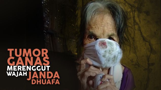 Nenek Hamidah Kehilangan Wajahnya Akibat Tumor