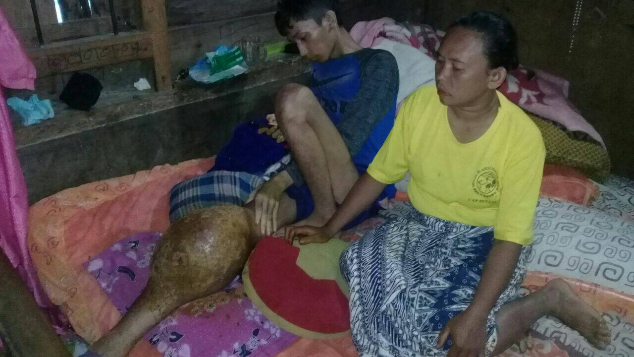 Bantu Fajar Sagala melawan pembengkakan dikakinya