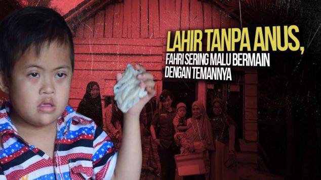 9 Tahun Fahri Hidup Tanpa Anus dan Down Syndrome