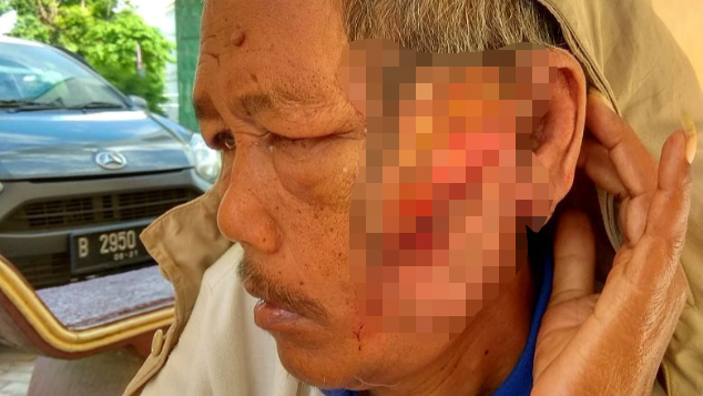 Tolong Selamet Melawan Kanker di wajah nya