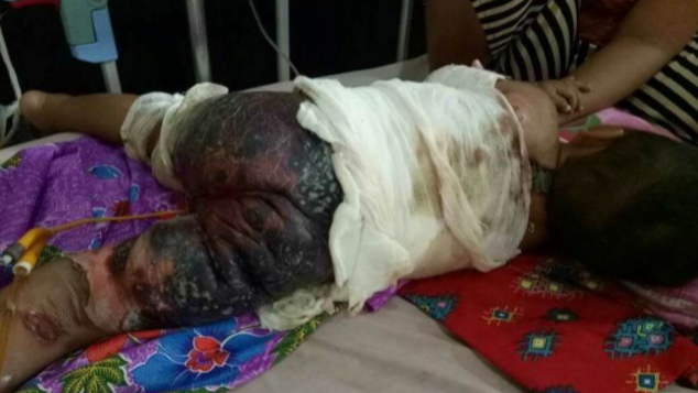 Mari Bantu Adik Syahrul yang Menderita Luka Bakar