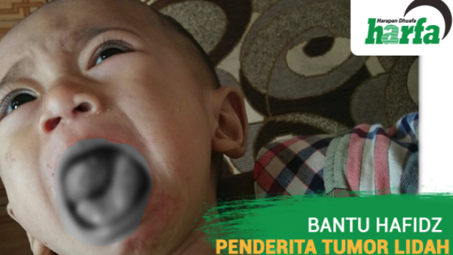 Kado Lebaran untuk Hafidz Penderita Tumor Lidah