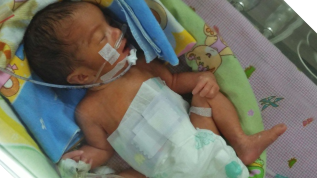 Bantu Azeema Sembuh dari Atresia Duodenum