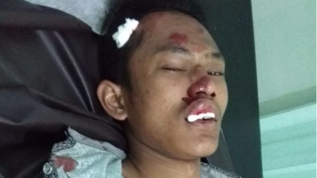 Bantu frans melawan pendarahan otak