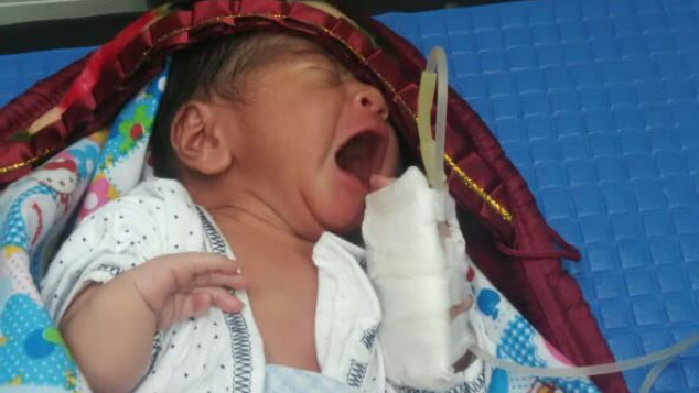 Baby Adam lawan kelainan tulang dan atresia ani