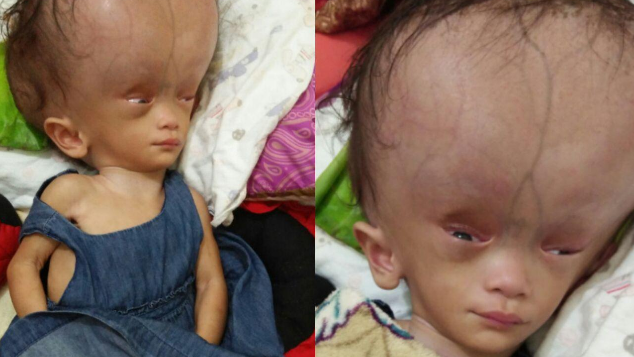 Bantu Alesha sembuh dari Meningokel & Hidrosefalus