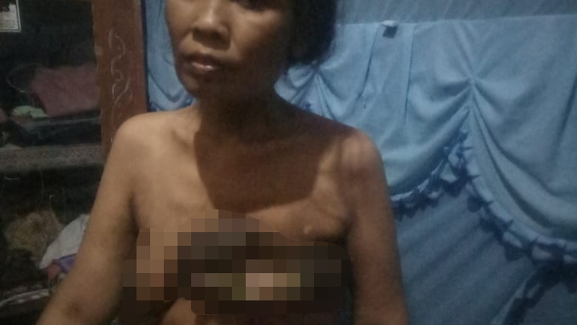 Bantu ibunda uzlifa Mela kanker payudara
