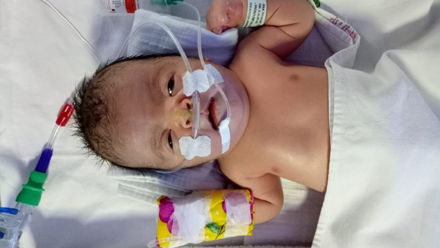 Bantu Baby Emir melawan Apert Sindrom