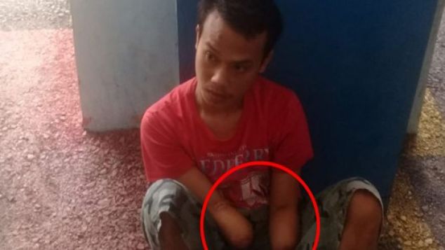 Tersengat Listrik, Dua Tangan Dede Diamputasi