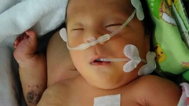 Bantu Abdillah Lawan Hemangioma
