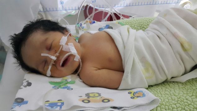 Bantu Bayi Kallula dengan Atresia Esofagus