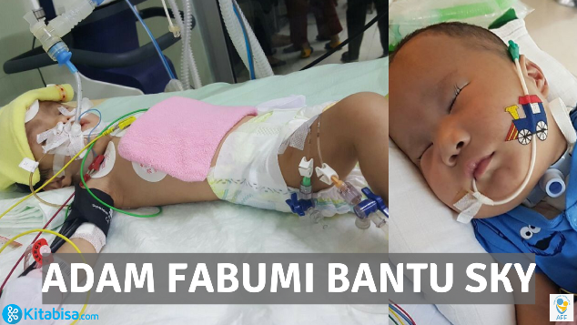 Adam Fabumi Bantu Sky "Pejuang Trisomy 18"