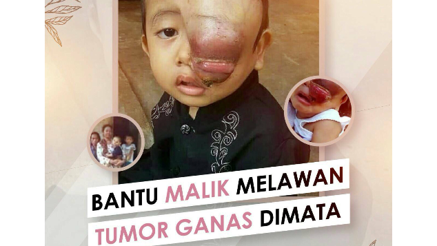 BANTU MALIK MELAWAN TUMOR GANAS DI MATA