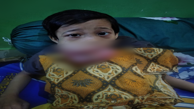Perjuangan Hadi melawan Tumor tulang