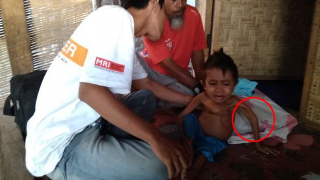 Hafidz (7 tahun), Korban Gempa Lombok Berat 6 kg