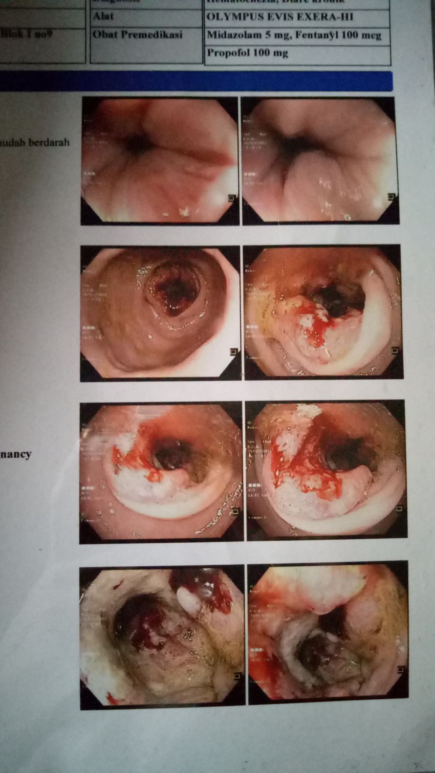 hasil dari kolonoskopi bapak